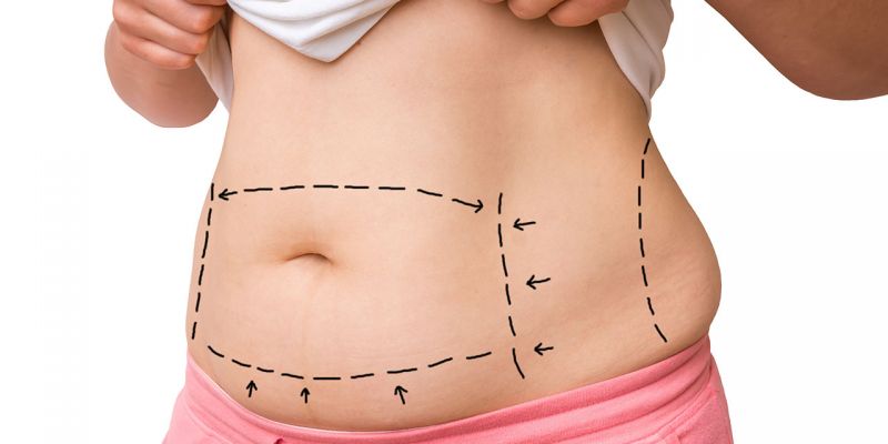 Liposuction Nedir?